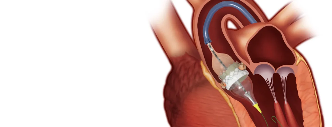 TAVR Surgery Cost in Bikaner: Is Non-Surgical Valve Replacement Affordable?